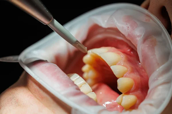 Zbliżenie Zębów Badanie Dentystyczne Gabinecie Stomatologicznym Dentysta Bada Zęby Pacjenta — Zdjęcie stockowe