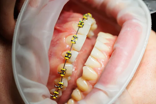 Diş Uzatıcısı Diş Hekiminde Diş Teli Takan Bir Kadının Dişleri — Stok fotoğraf
