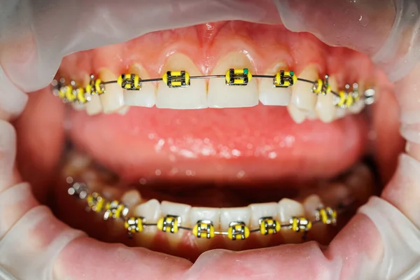 Diş Uzatıcısı Diş Hekiminde Diş Teli Takan Bir Kadının Dişleri — Stok fotoğraf