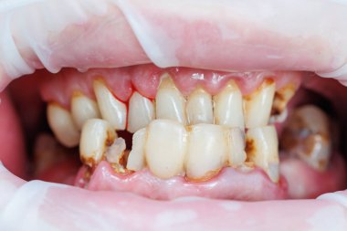 Bozuk dişler, kötü diş temizliği, bakteriler, ağız hastalıkları. Parçalanmış dişler