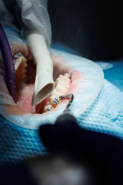 Hastanın dişlerini fırçalama sürecinin en üst görüntüsü. Su jeti ve tükürük püskürtücüyle diş temizliği. Dudaklarda yanak retraktörü. Profesyonel ağız temizliği kavramı. Diş telleri.