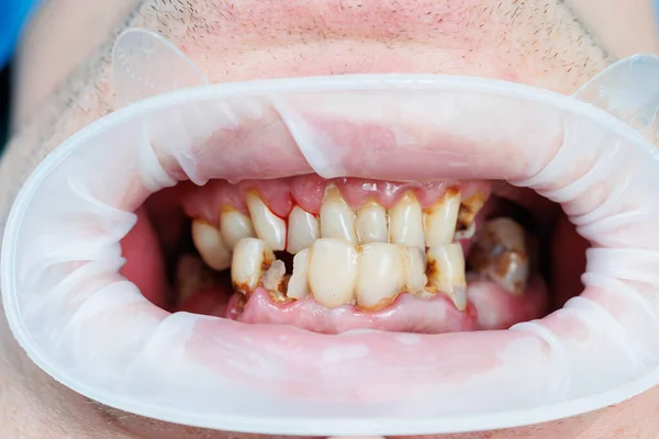 Denti Rovinati Scarsa Igiene Dentale Carie Malattia Della Bocca Denti — Foto Stock