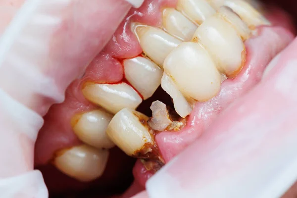 Zepsute Zęby Słaba Higiena Zębów Próchnica Choroba Jamy Ustnej Połamane — Zdjęcie stockowe