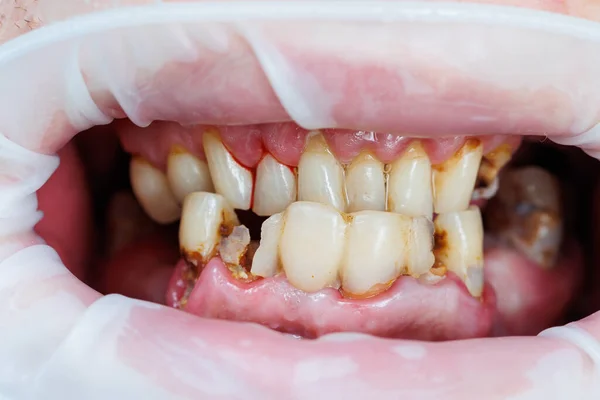 Zepsute Zęby Słaba Higiena Zębów Próchnica Choroba Jamy Ustnej Połamane — Zdjęcie stockowe
