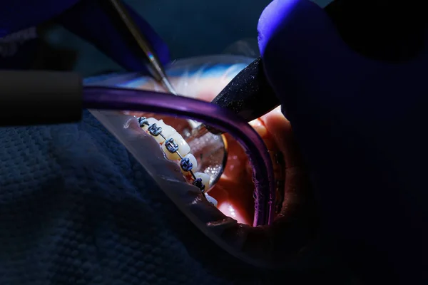 Tandarts Behandelt Tanden Van Patiënt Met Tandheelkundige Apparatuur Houdt Tandheelkundige — Stockfoto