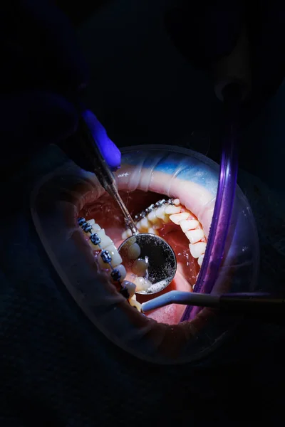 Стоматолог Лікує Зуби Пацієнта Стоматологічним Обладнанням Тримає Стоматологічні Інструменти Біля — стокове фото