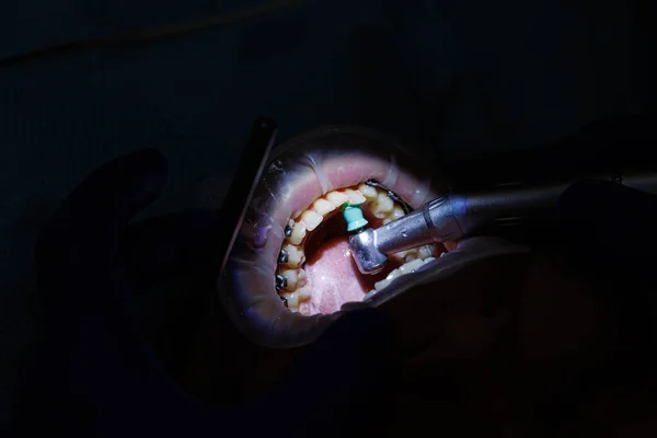Dentysta Traktuje Zęby Pacjenta Sprzętem Stomatologicznym Trzyma Instrumenty Stomatologiczne Pobliżu — Zdjęcie stockowe