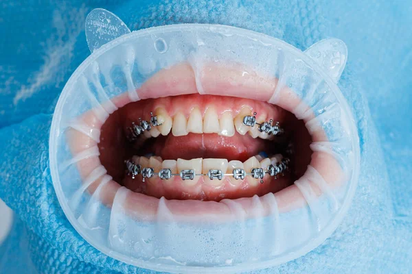 Κοντινό Πλάνο Δοντιών Σιδεράκια Οδοντιατρικό Τσεκ Στο Οδοντιατρείο Οδοντίατρος Εξετάζει — Φωτογραφία Αρχείου