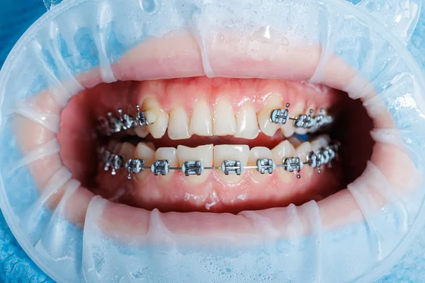 Zbliżenie Zębów Aparatem Zębach Badanie Stomatologiczne Gabinecie Stomatologicznym Dentysta Bada — Zdjęcie stockowe