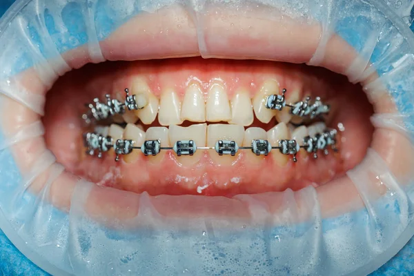 Крупним Планом Зуби Брекетами Огляд Зубів Стоматологічному Кабінеті Стоматолог Оглядає — стокове фото