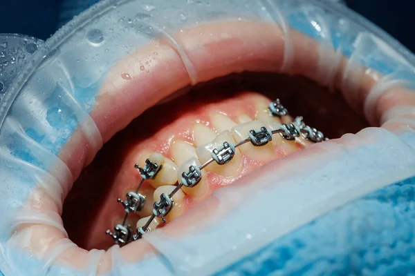 ブレースで歯のクローズアップ 歯科事務所での歯科検査 歯医者は患者の歯を歯科器具で検査する 選択的焦点 — ストック写真