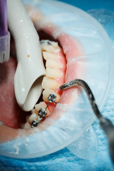Draufsicht Auf Den Prozess Des Zähneputzens Des Patienten Zahnreinigung Mit — Stockfoto