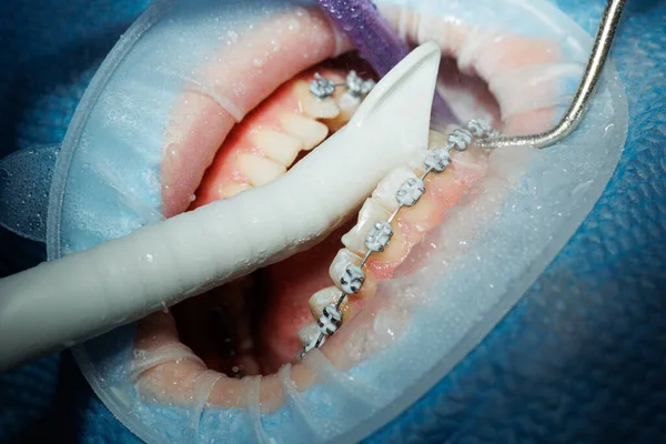 Widok Góry Procesu Mycia Zębów Pacjenta Czyszczenie Zębów Strumieniem Wody — Zdjęcie stockowe