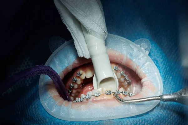 患者の歯をブラッシングするプロセスのトップビュー ウォータージェットと唾液エジェクターで歯のクリーニング 唇に頬のリトラクター プロの口腔衛生の概念 歯の上の歯の歯 — ストック写真