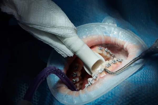 Widok Góry Procesu Mycia Zębów Pacjenta Czyszczenie Zębów Strumieniem Wody — Zdjęcie stockowe