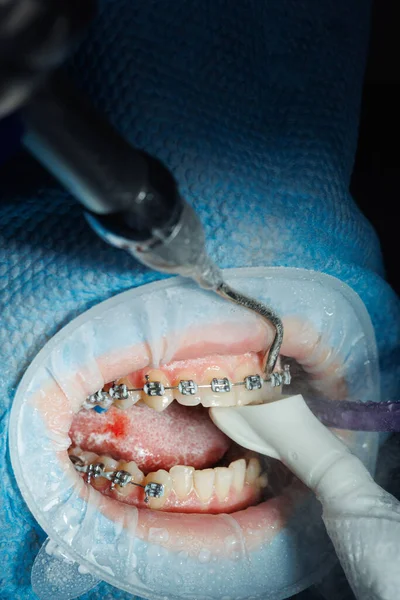 患者の歯をブラッシングするプロセスのトップビュー ウォータージェットと唾液エジェクターで歯のクリーニング 唇に頬のリトラクター プロの口腔衛生の概念 歯の上の歯の歯 — ストック写真