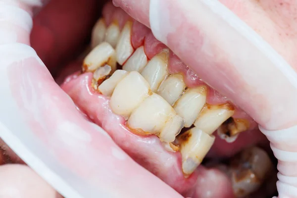 こぼれた歯 貧しい歯科衛生 口の病気 歯が砕けて — ストック写真