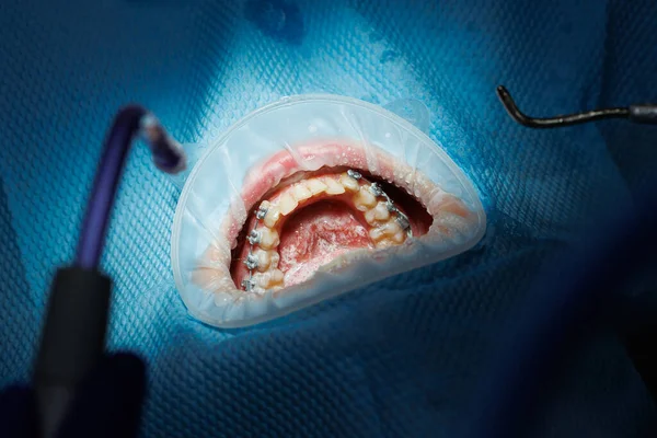 Κάτοψη Της Διαδικασίας Βουρτσίσματος Των Δοντιών Του Ασθενούς Καθαρισμός Δοντιών — Φωτογραφία Αρχείου
