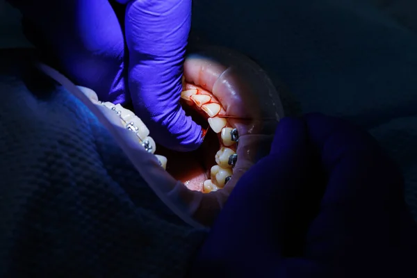 Dentysta Traktuje Zęby Pacjenta Sprzętem Stomatologicznym Trzyma Instrumenty Stomatologiczne Pobliżu — Zdjęcie stockowe