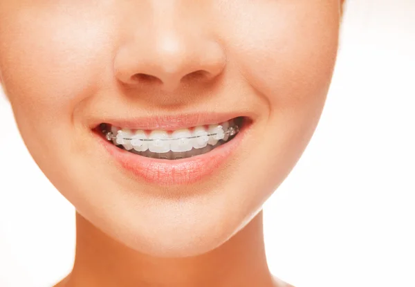 Braces on teeth, close-up — Stock Photo, Image