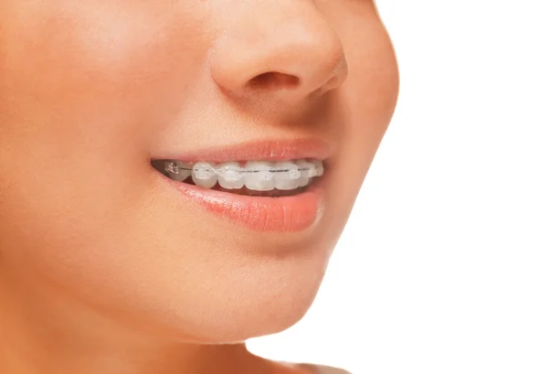 Braces on teeth — Stock Photo, Image