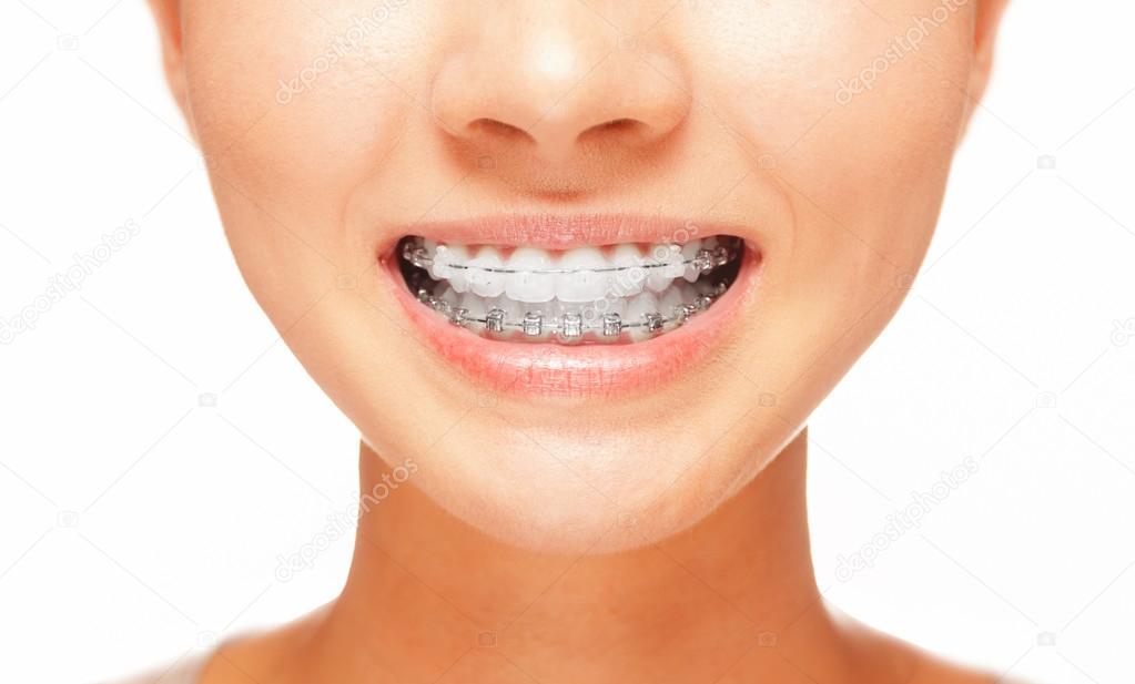 Smile: teeth with braces