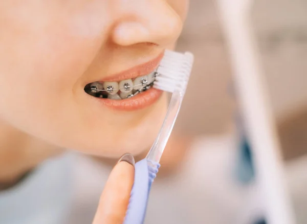 Mujer joven con aparatos ortopédicos en los dientes cepillándose los dientes con un cepillo de dientes, de cerca, delante del espejo. — Foto de Stock
