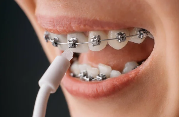 Unrecognizable woman with braces cleaning her teeth with oral irrigator, close-up. — Stock Photo, Image