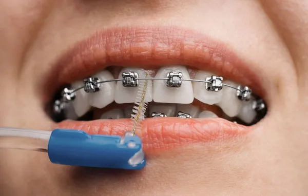 Mujer joven limpia aparatos ortopédicos con un cepillo dental, primer plano. — Foto de Stock