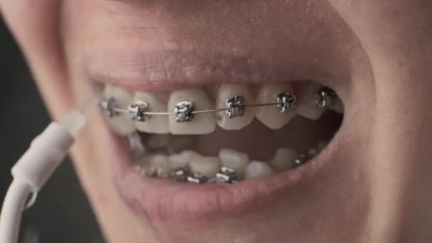 Зубы крупным планом с брекетами и ирригатором. Молодая неузнаваемая женщина пользуется ирригатором. — стоковое видео