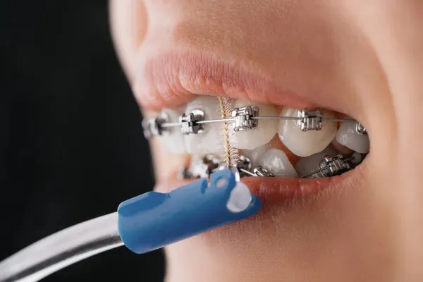 Mulher jovem irreconhecível limpa aparelhos com uma escova dental, close-up. — Fotografia de Stock