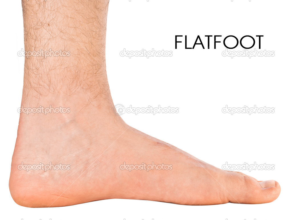 Men's foot. Flatfoot second degree.