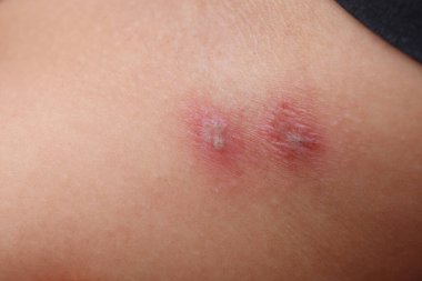 Zona (hastalık), Herpes zoster, varicella - zoster virüsü. deri döküntüsü ve vücut üzerinde kabarcıklar