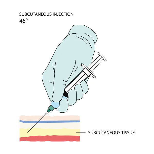 Subcutane Injectie Effectieve Methoden Voor Het Toedienen Van Geneesmiddelen Andere — Stockvector