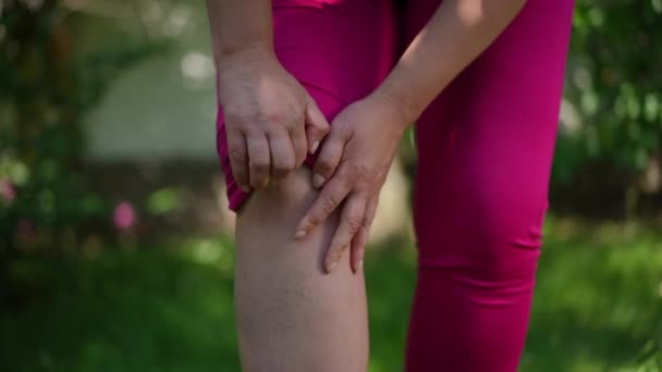 Unrecognizable Size Woman Raising Leggings Showing Bruise Slow Motion Motivated — Stockvideo