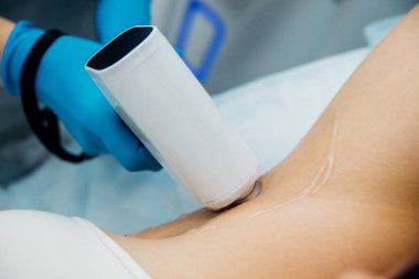 Koltuk altında lazer tüy çıkarma prosedürü. Şekerleme işlemi için şeker macunu uygulaması. Cilt bakımı, kozmetik prosedürleri..