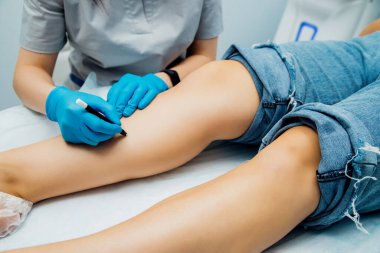 Mavi eldivenli kadınların elleri bölgeyi bir kalemle epilasyon ve benlerin korunması için işaretliyor. Cilt bakımı. Kadın bacaklarının lazerle kesilmesi..