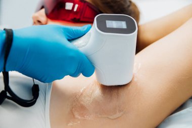 Koltuk altında lazer tüy çıkarma prosedürü. Şekerleme işlemi için şeker macunu uygulaması. Cilt bakımı, kozmetik prosedürleri..