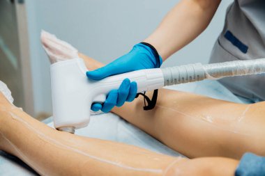 Kadınların bacaklarının lazerle kesilmesi prosedürü. Şekerleme işlemi için şeker macunu uygulaması. Cilt bakımı, kozmetik prosedürleri..