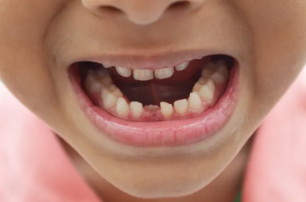 Primi denti da bambino fuori sdentato sorriso primo piano — Foto Stock