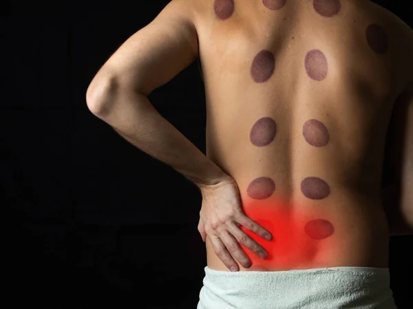man with lower back pain. traditional medicine. traces of treatment with cans on the back