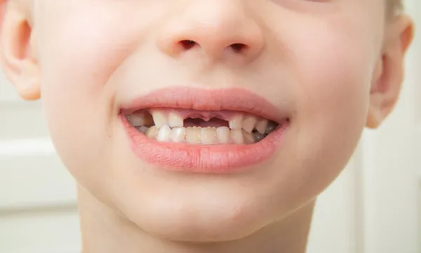 Ein Junge Ohne Milchfront Obere Zwei Zähne Einem Shirt Auf — Stockfoto