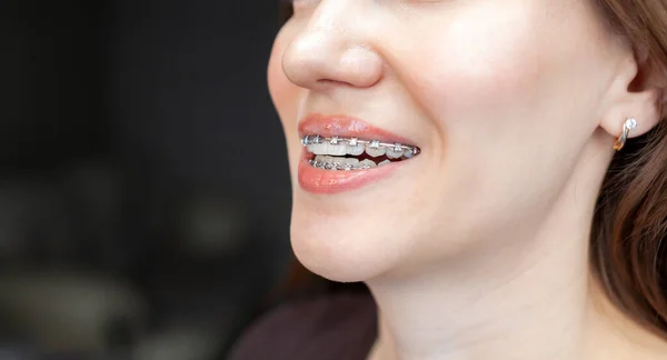 Ung Och Vacker Flickas Leende Med Tandställning Sina Vita Tänder — Stockfoto