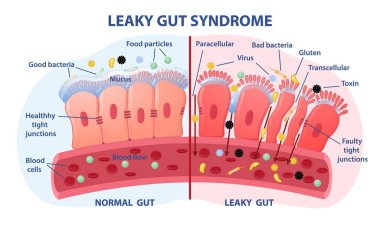 Leaky gut Syndrome concept clipart