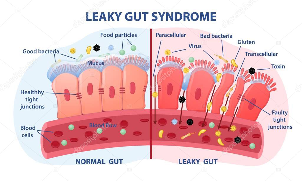 Leaky gut Syndrome concept