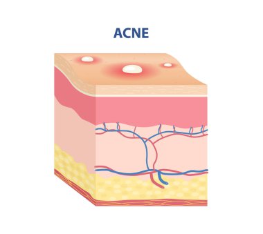 Cilt Tipi Yapıştırıcısı