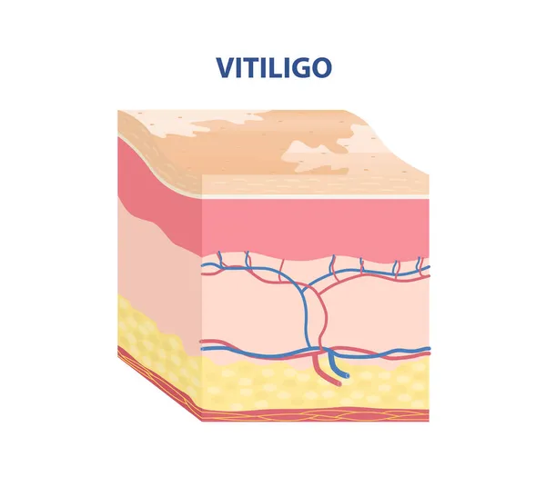 Tipo di pelle Adesivo — Vettoriale Stock