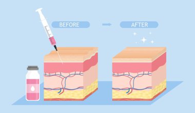 Skin rejuvenation concept. Metaphor of cosmetic procedures, beauty and hygiene. Doctors inject cosmetic products with syringe. Fight wrinkles and blackheads. Cartoon flat vector illustration