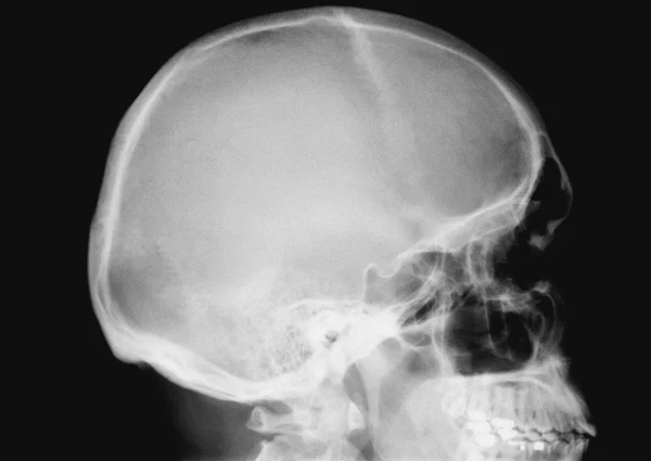 Röntgenbilden av människans kranium — Stockfoto
