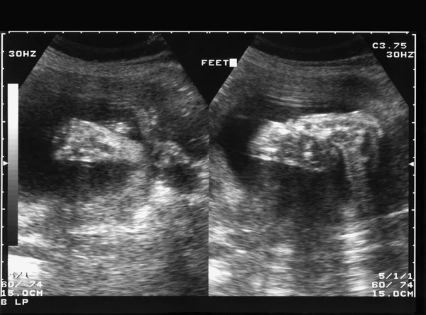 Graviditet scan — Stockfoto